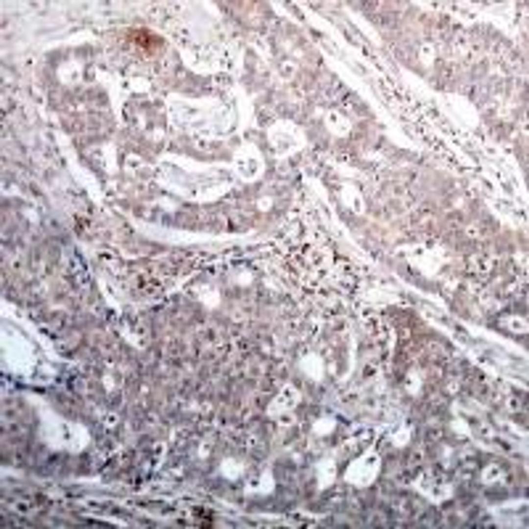 Immunohistochemical analysis of paraffin-embedded human breast carcinoma tissue using IkappaB-&#946; (Phospho-Ser23).