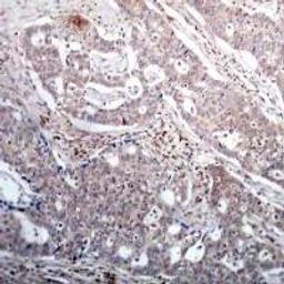 Immunohistochemical analysis of paraffin-embedded human breast carcinoma tissue using IkappaB-&#946; (Phospho-Ser23).