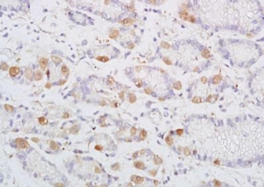 Immunohistochemical analysis of formalin-fixed paraffin embedded human colon carcinoma tissue using DENND2D antibody (dilution at 1:200)