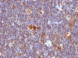 Formalin-fixed, paraffin-embedded human Hodgkin's lymphoma stained with anti-Bax antibody (Clone SPM336).