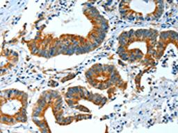 The image on the left is immunohistochemistry of paraffin-embedded Human colon cancer tissue using CSB-PA245428(BAG3 Antibody) at dilution 1/25, on the right is treated with fusion protein. (Original magnification: ×200)