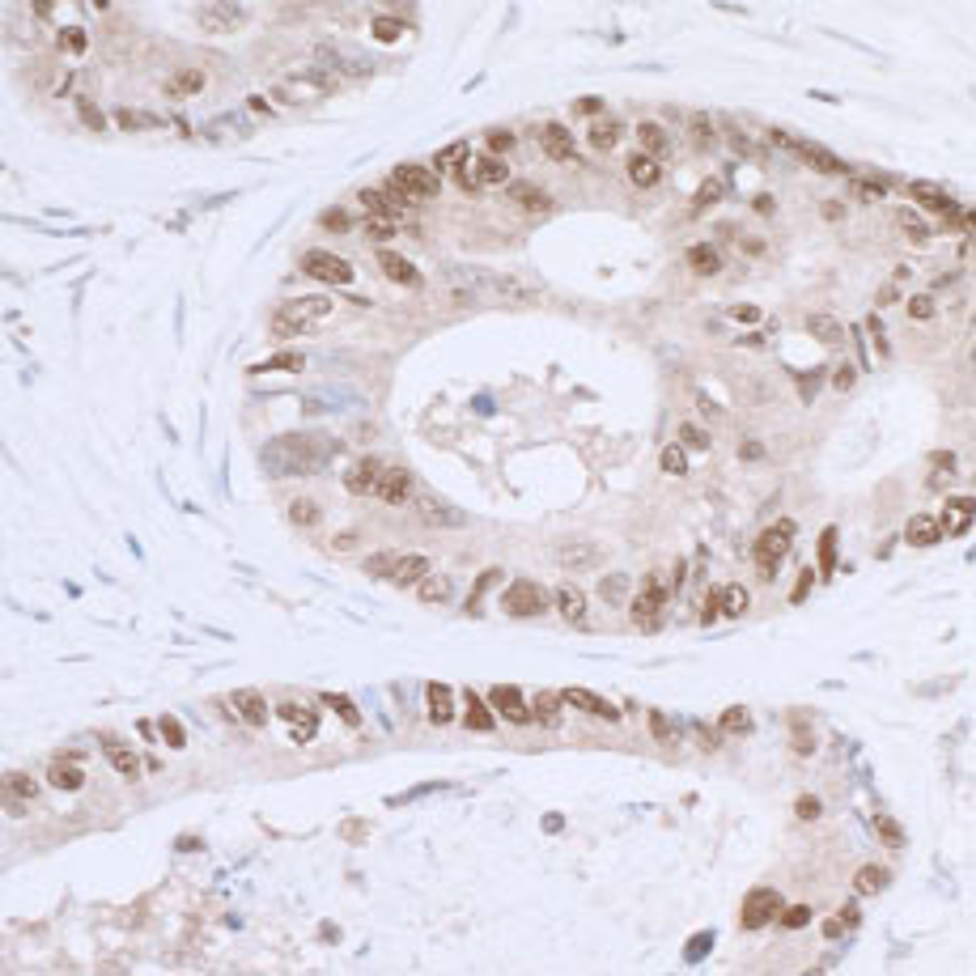 Detection of human p53 by immunohistochemistry.