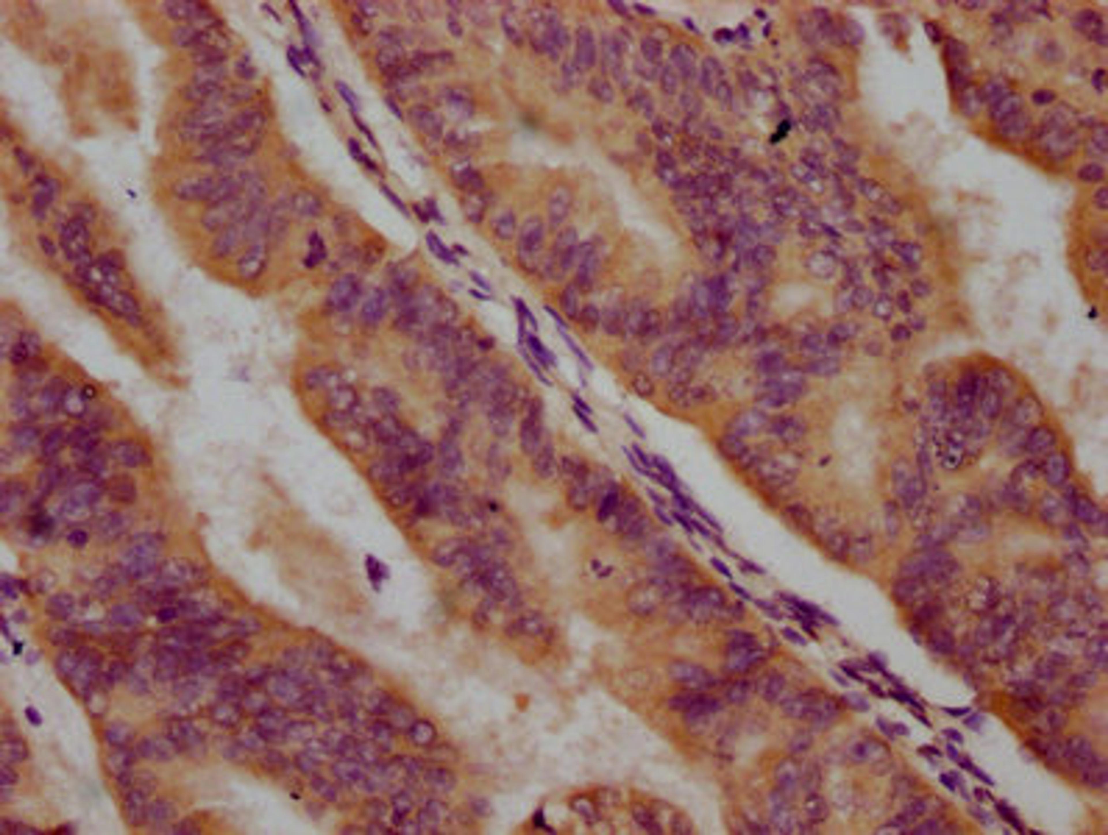 IHC image of CSB-PA018433LA01HU diluted at 1:500 and staining in paraffin-embedded human endometrial cancer performed on a Leica BondTM system. After dewaxing and hydration, antigen retrieval was mediated by high pressure in a citrate buffer (pH 6.0). Section was blocked with 10% normal goat serum 30min at RT. Then primary antibody (1% BSA) was incubated at 4&deg;C overnight. The primary is detected by a biotinylated secondary antibody and visualized using an HRP conjugated SP system.