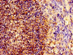 Immunohistochemistry of paraffin-embedded human ovarian cancer using CSB-PA015949LA01HU at dilution of 1:100