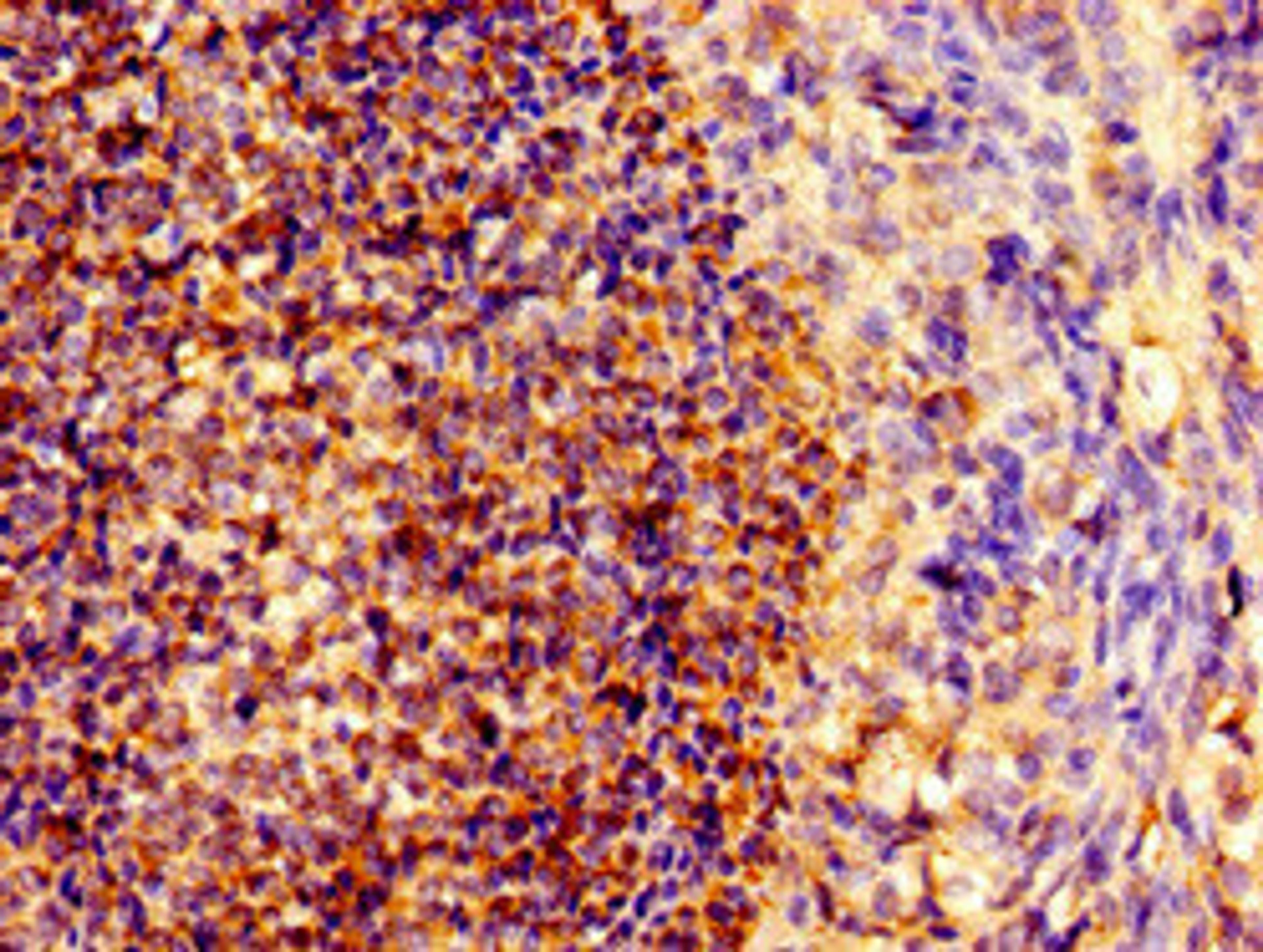 Immunohistochemistry of paraffin-embedded human ovarian cancer using CSB-PA015949LA01HU at dilution of 1:100