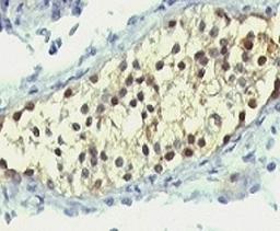 Formalin-fixed, paraffin-embedded human testicular carcinoma stained with anti-Thymidylate Synthase antibody (SPM453).