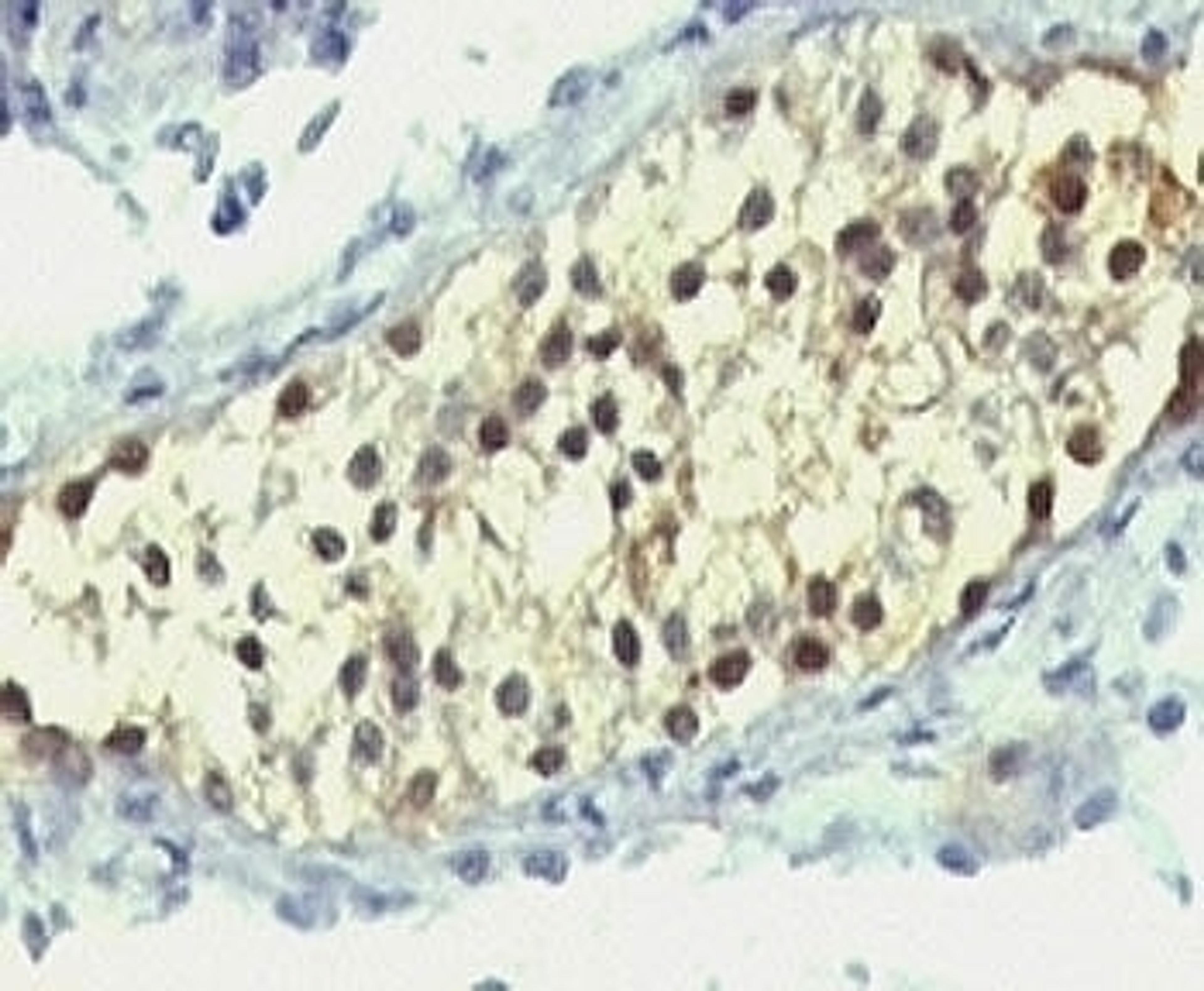 Formalin-fixed, paraffin-embedded human testicular carcinoma stained with anti-Thymidylate Synthase antibody (SPM453).