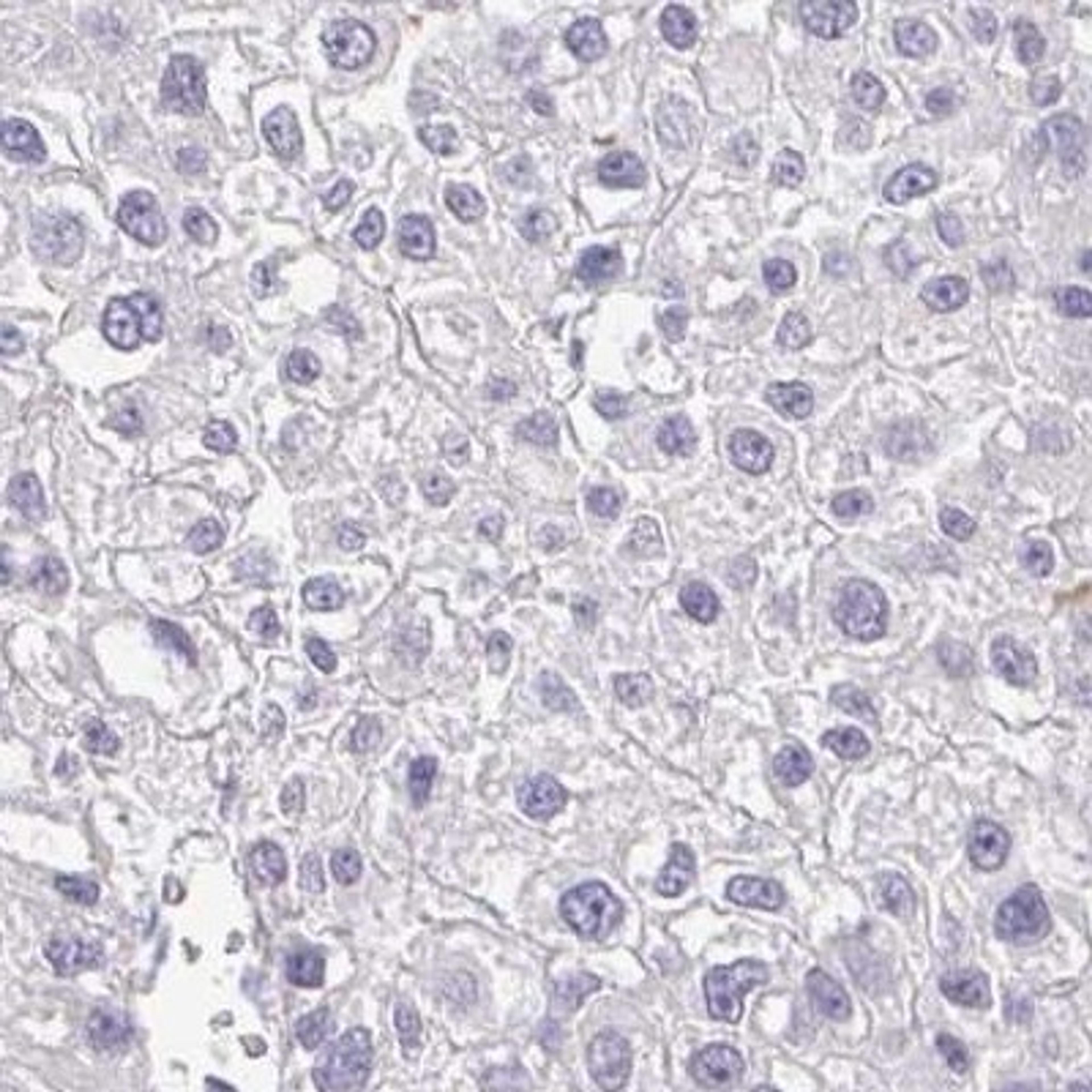 Immunohistochemistry: OR51D1 Antibody [NBP2-32590] - liver cancer