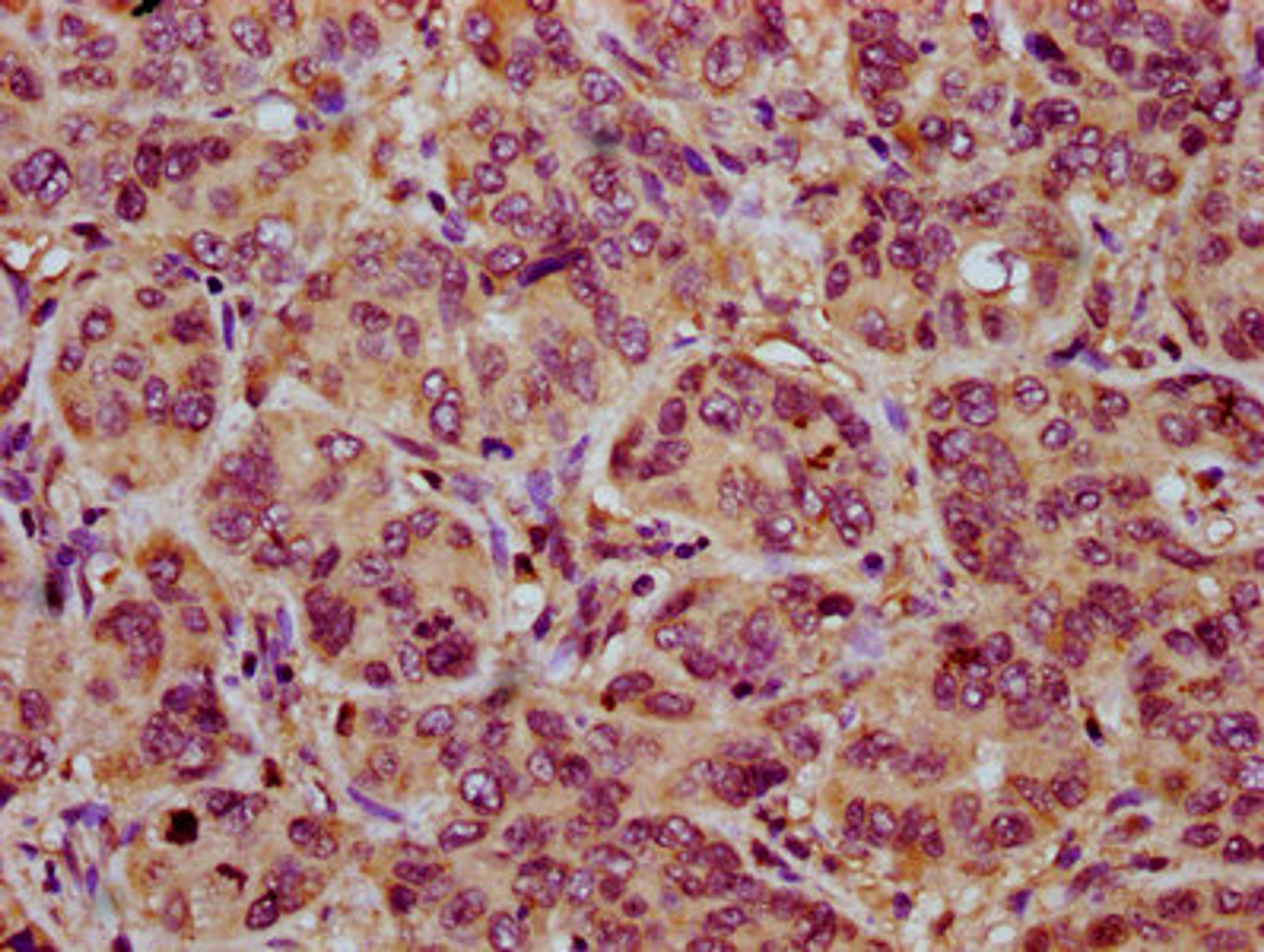 IHC image of CSB-PA015964LA01HU diluted at 1:200 and staining in paraffin-embedded human liver cancer performed on a Leica BondTM system. After dewaxing and hydration, antigen retrieval was mediated by high pressure in a citrate buffer (pH 6.0). Section was blocked with 10% normal goat serum 30min at RT. Then primary antibody (1% BSA) was incubated at 4°C overnight. The primary is detected by a biotinylated secondary antibody and visualized using an HRP conjugated SP system.