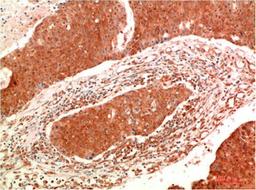 Immunohistochemical analysis of paraffin-embedded Human Breast Carcinoma Tissue using JAK2 Mouse mAb diluted at 1:200.