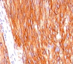 Formalin-paraffin human gastrointestinal stromal tumor (GIST) stained with CD117 antibody (C117/370).