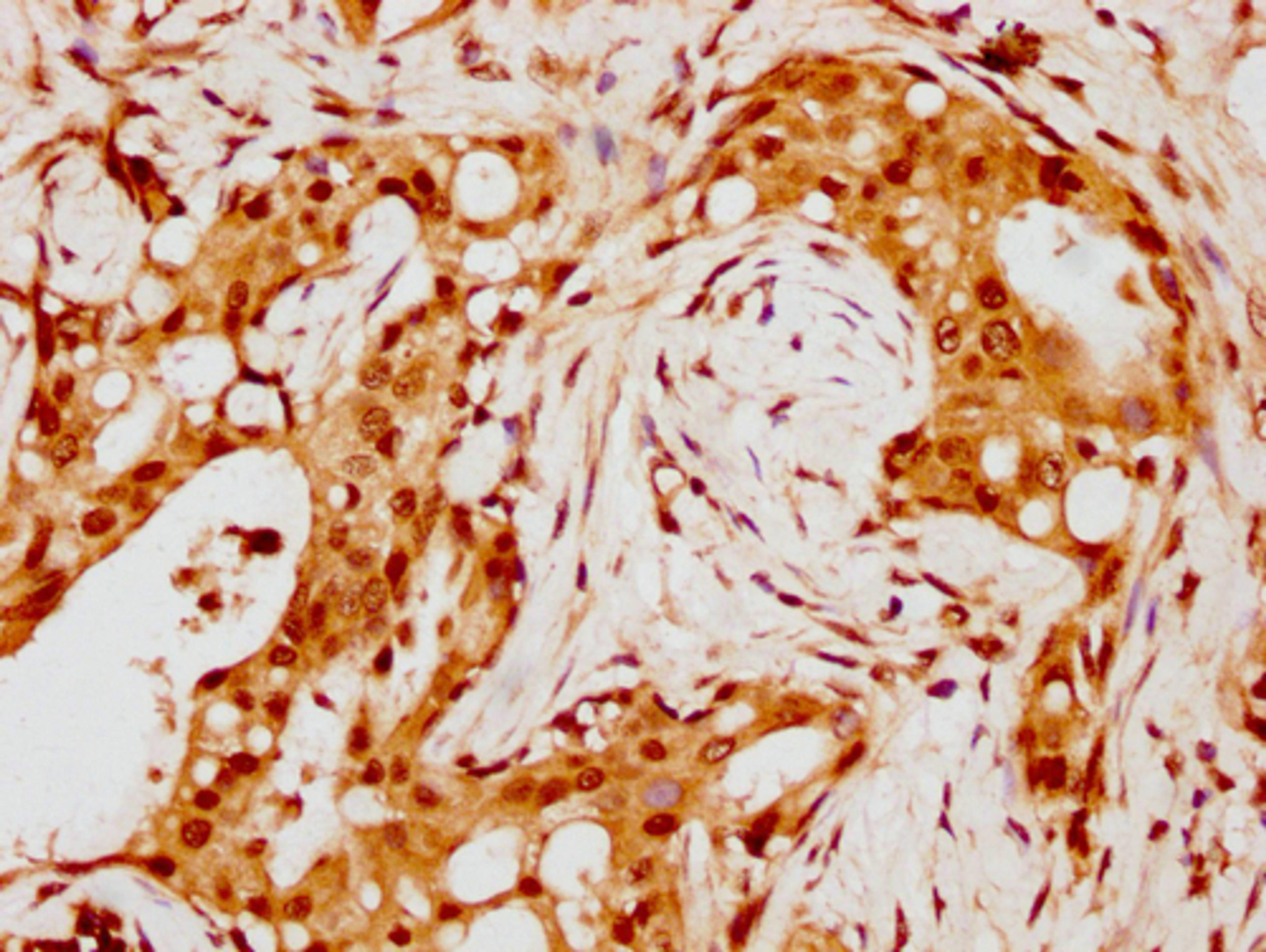 IHC image of CSB-PA010429PA88nohHU diluted at 1:8 and staining in paraffin-embedded human breast cancer performed on a Leica BondTM system. After dewaxing and hydration, antigen retrieval was mediated by high pressure in a citrate buffer (pH 6.0). Section was blocked with 10% normal goat serum 30min at RT. Then primary antibody (1% BSA) was incubated at 4°C overnight. The primary is detected by a biotinylated secondary antibody and visualized using an HRP conjugated SP system.