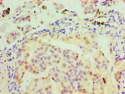 Immunohistochemical of paraffin-embedded Human lung cancer tissue using CSB-MA0150321A0m at dilution of 1:200.