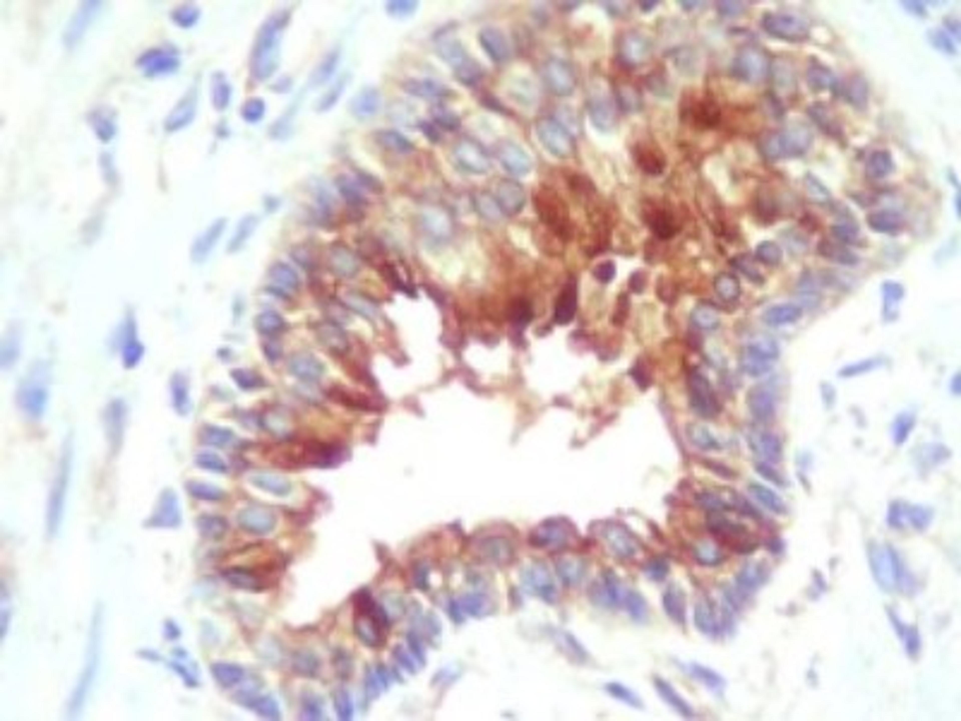 Immunohistochemistry: cIAP-2/HIAP-1 Antibody [NBP1-27972] - Analysis of human adenocarcinoma cells and adjacent glands using anti-cIAP2.