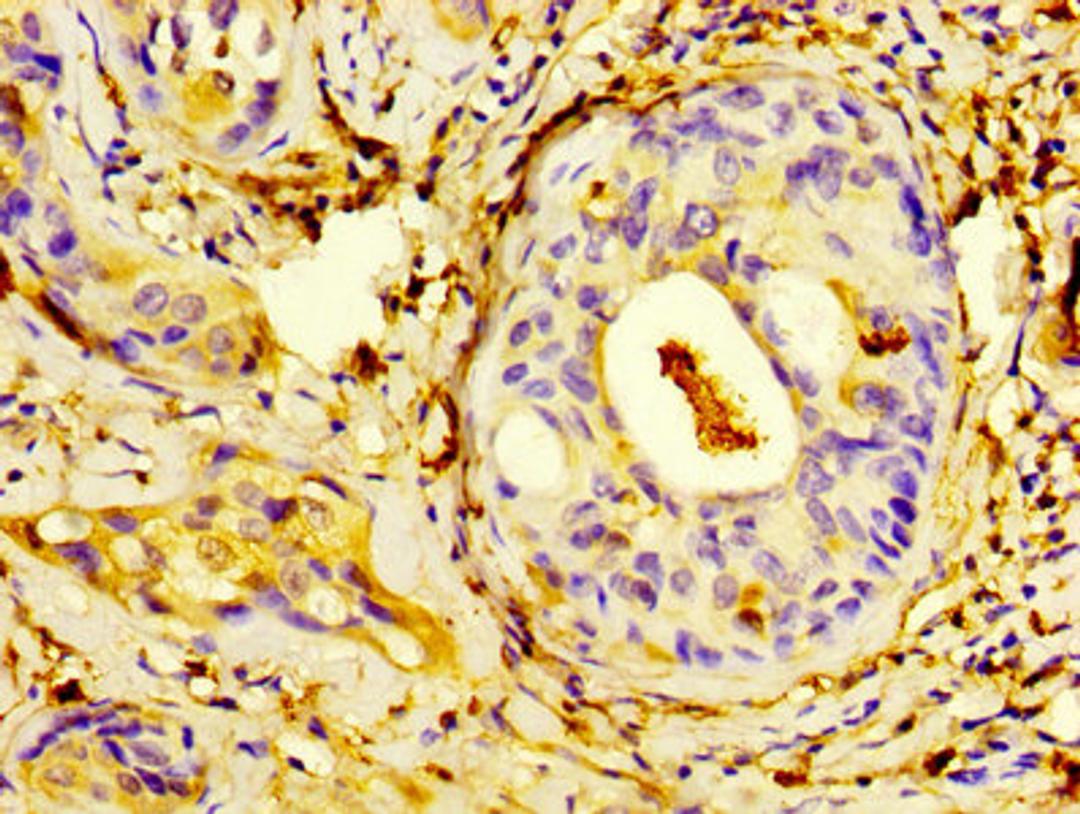 IHC image of CSB-PA020642HA01HU diluted at 1:400 and staining in paraffin-embedded human cervical cancer performed on a Leica BondTM system. After dewaxing and hydration, antigen retrieval was mediated by high pressure in a citrate buffer (pH 6.0). Section was blocked with 10% normal goat serum 30min at RT. Then primary antibody (1% BSA) was incubated at 4&deg;C overnight. The primary is detected by a biotinylated secondary antibody and visualized using an HRP conjugated SP system.