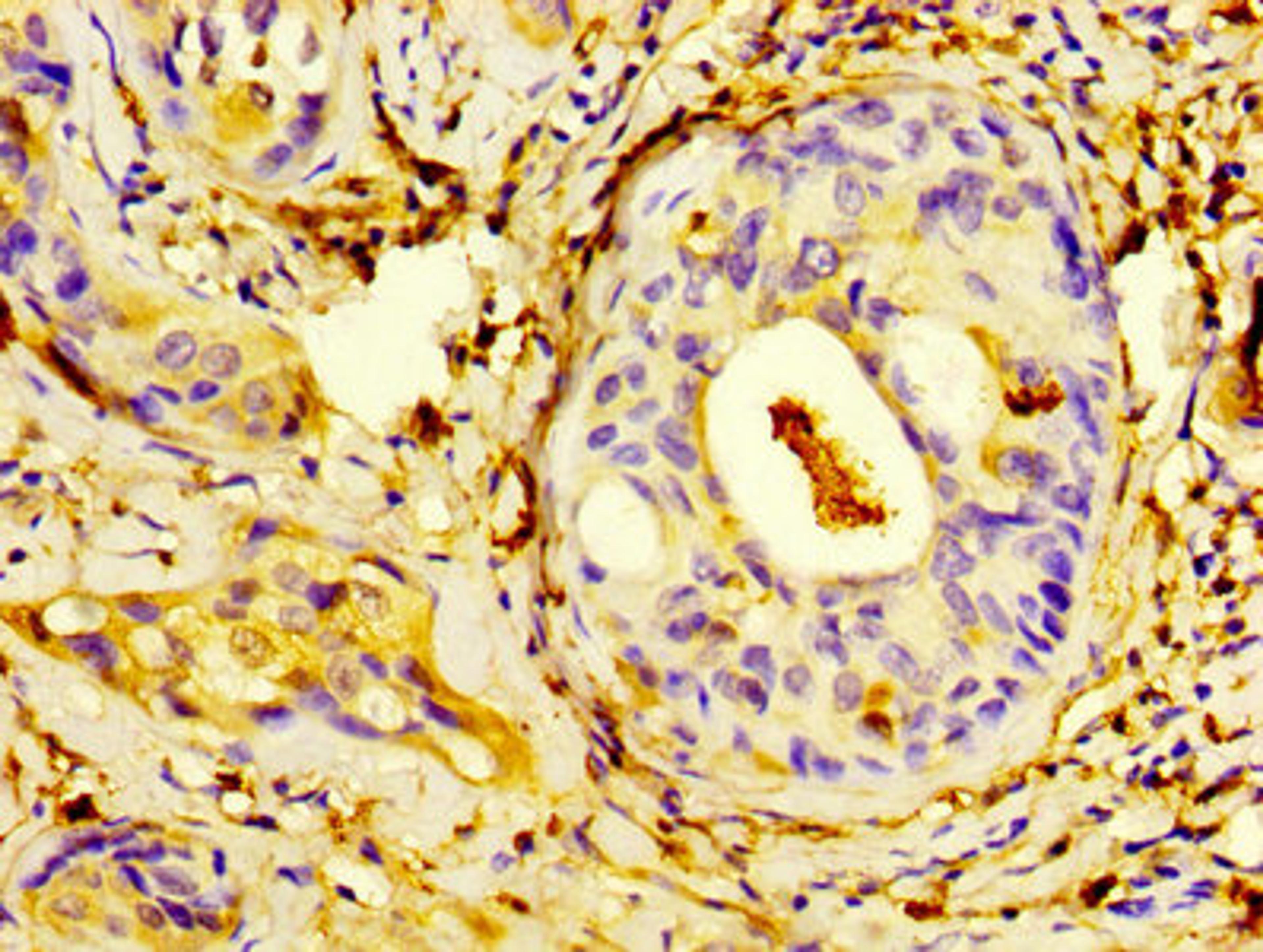 IHC image of CSB-PA020642HA01HU diluted at 1:400 and staining in paraffin-embedded human cervical cancer performed on a Leica BondTM system. After dewaxing and hydration, antigen retrieval was mediated by high pressure in a citrate buffer (pH 6.0). Section was blocked with 10% normal goat serum 30min at RT. Then primary antibody (1% BSA) was incubated at 4&deg;C overnight. The primary is detected by a biotinylated secondary antibody and visualized using an HRP conjugated SP system.