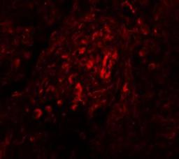 Immunocytochemistry/Immunofluorescence: BASC4 Antibody [NBP1-77126] - Immunofluorescence of BCAS4 in human breast carcinoma tissue with BCAS4 antibody at 20 ug/mL.