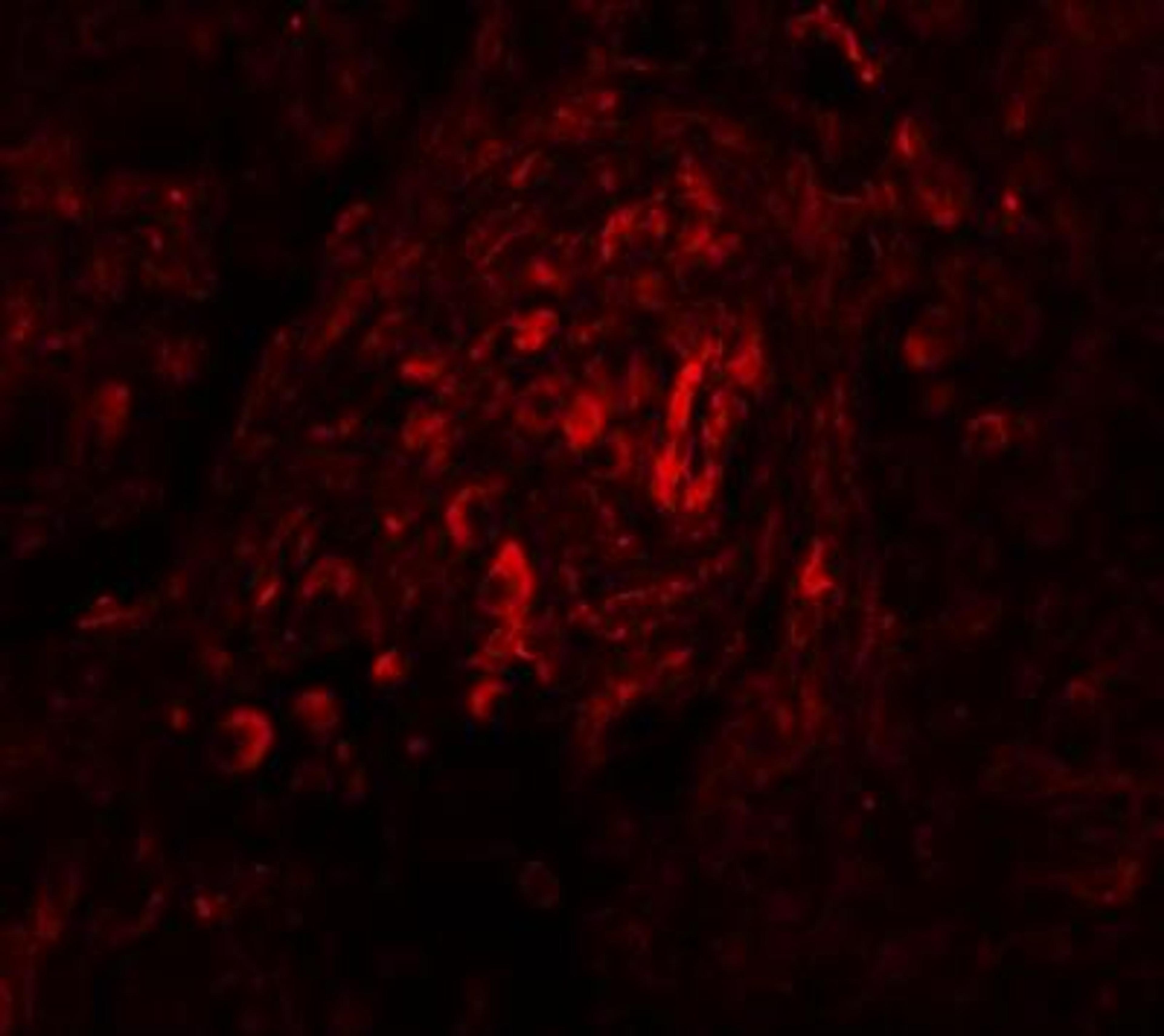 Immunocytochemistry/Immunofluorescence: BASC4 Antibody [NBP1-77126] - Immunofluorescence of BCAS4 in human breast carcinoma tissue with BCAS4 antibody at 20 ug/mL.