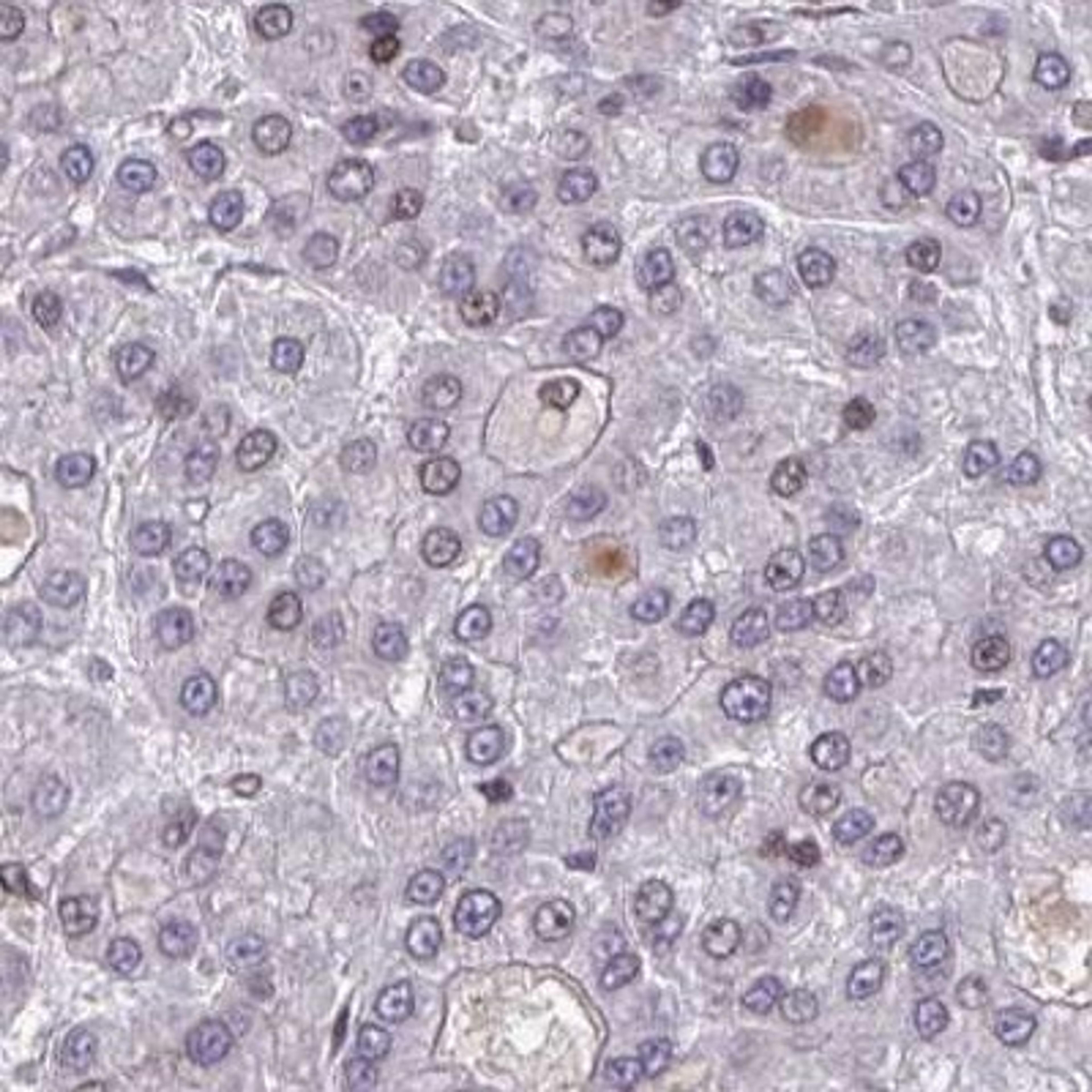 Immunohistochemistry: Protocadherin beta 8 Antibody [NBP2-31694] - liver cancer