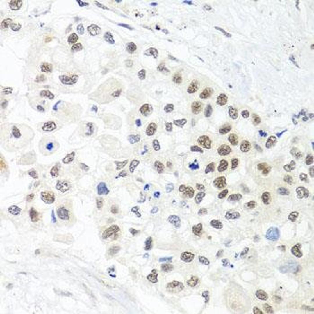 Immunohistochemical staining of human lung cancer tissue using TRMT1 antibody (dilution of 1:100)