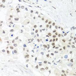 Immunohistochemical staining of human lung cancer tissue using TRMT1 antibody (dilution of 1:100)