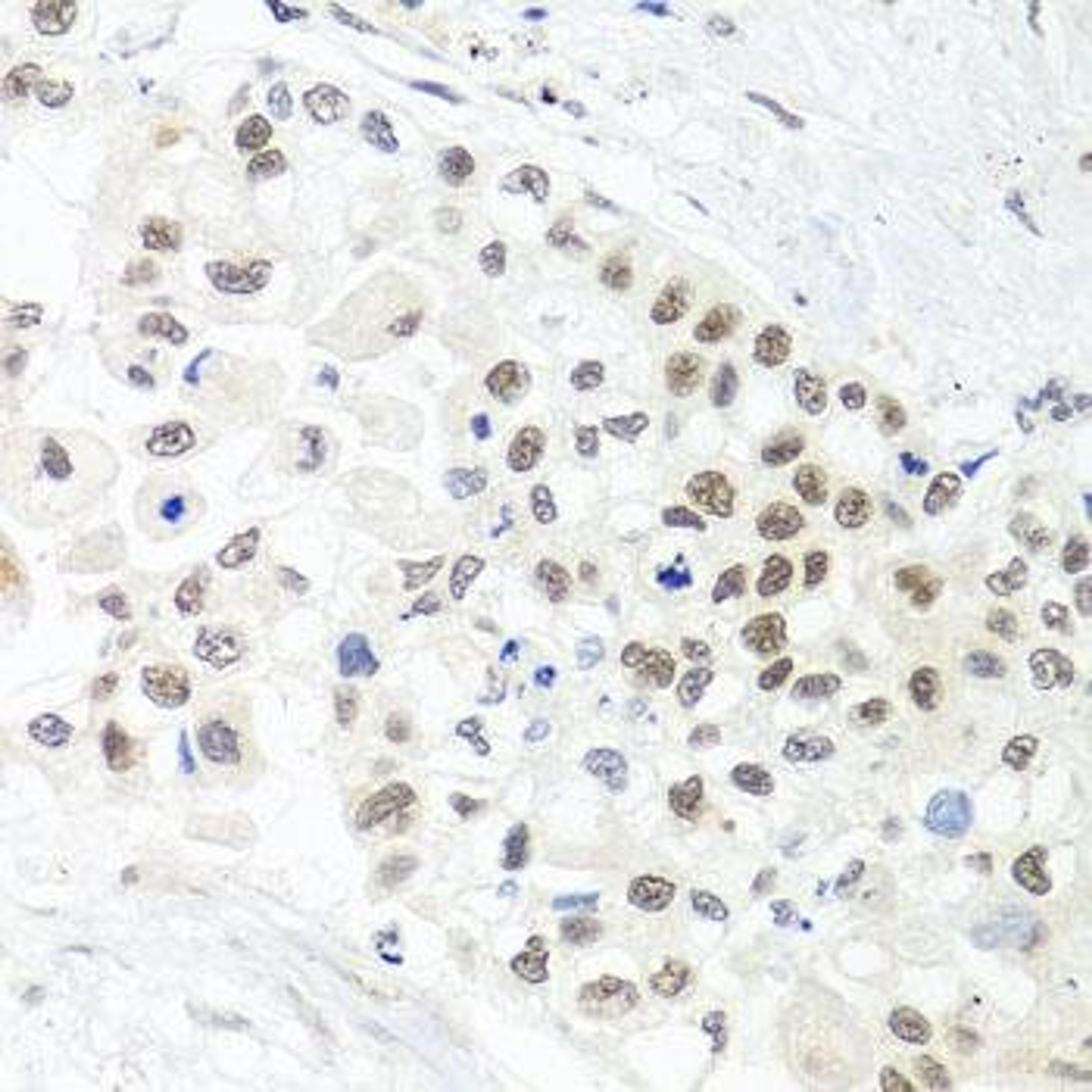 Immunohistochemical staining of human lung cancer tissue using TRMT1 antibody (dilution of 1:100)