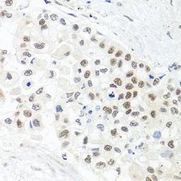 Immunohistochemical staining of human lung cancer tissue using TRMT1 antibody (dilution of 1:100)