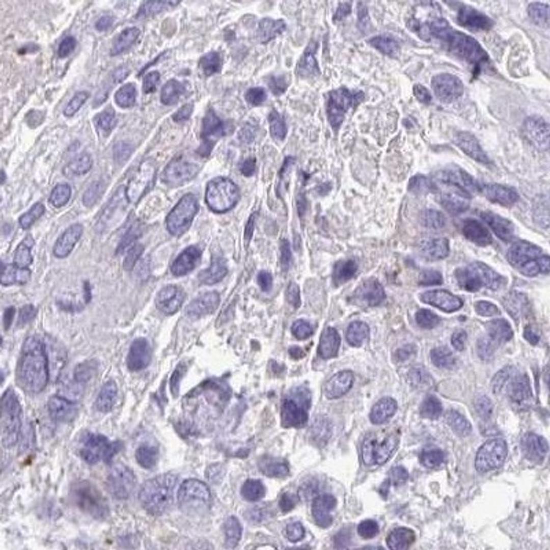 Immunohistochemistry: TMEM60 Antibody [NBP2-31862] - breast cancer