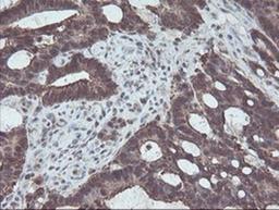 Immunohistochemistry-Paraffin: CBR3 Antibody (1G6) [NBP2-00997] - Staining of paraffin-embedded Adenocarcinoma of Human colon tissue using anti-CBR3 mouse monoclonal antibody.