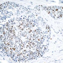 Detection of human FALZ/BPTF by immunohistochemistry.