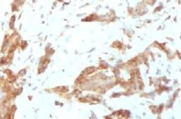 IHC testing of FFPE human breast carcinoma with GRP94 antibody (clone SRPR90b).