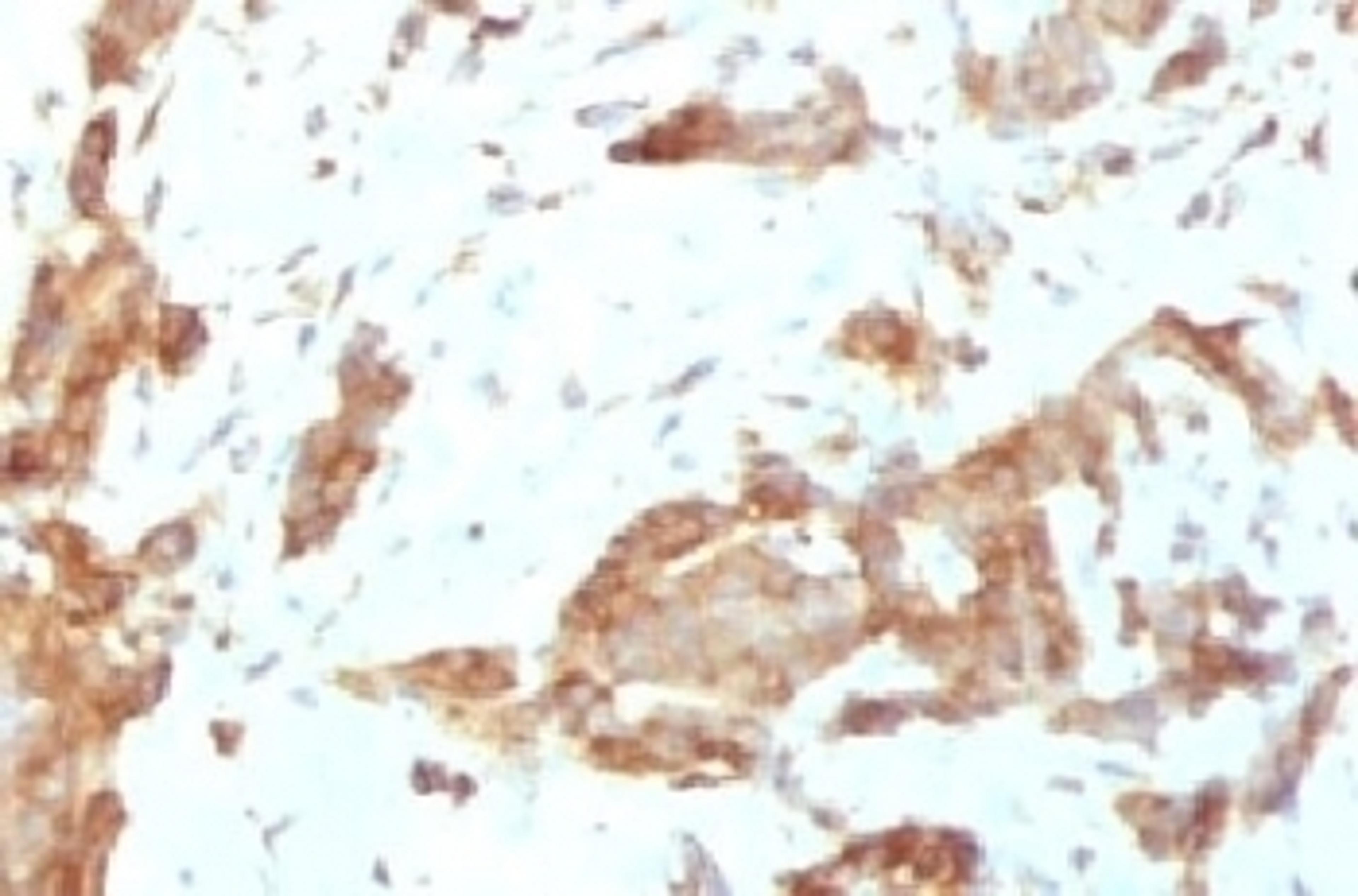 IHC testing of FFPE human breast carcinoma with GRP94 antibody (clone SRPR90b).