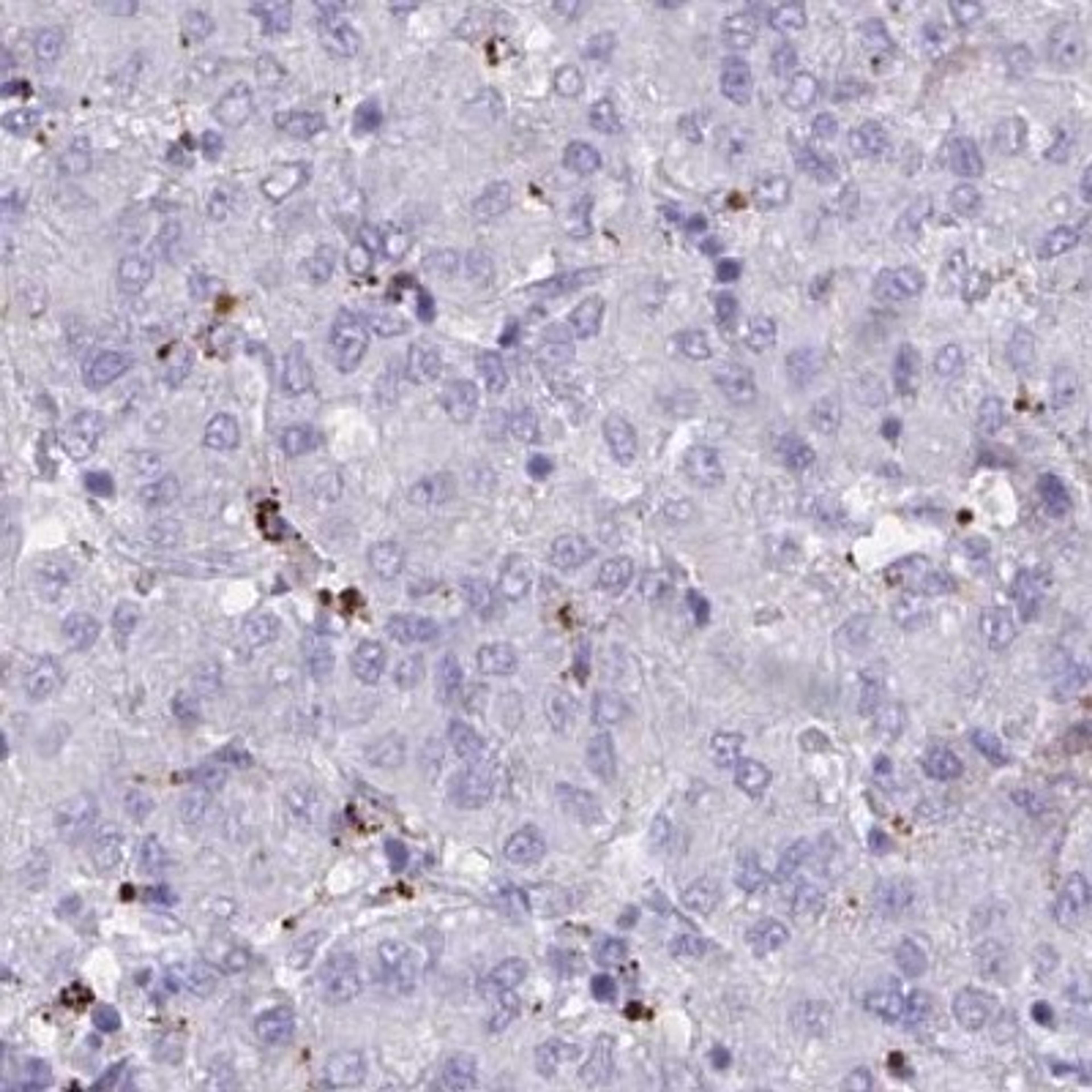 Immunohistochemistry: FAM219B Antibody [NBP2-31704] - liver cancer