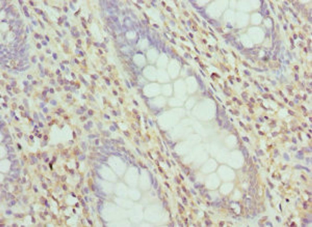Immunohistochemistry of paraffin-embedded human colon cancer using CSB-PA012955ESR1HU at dilution of 1:100