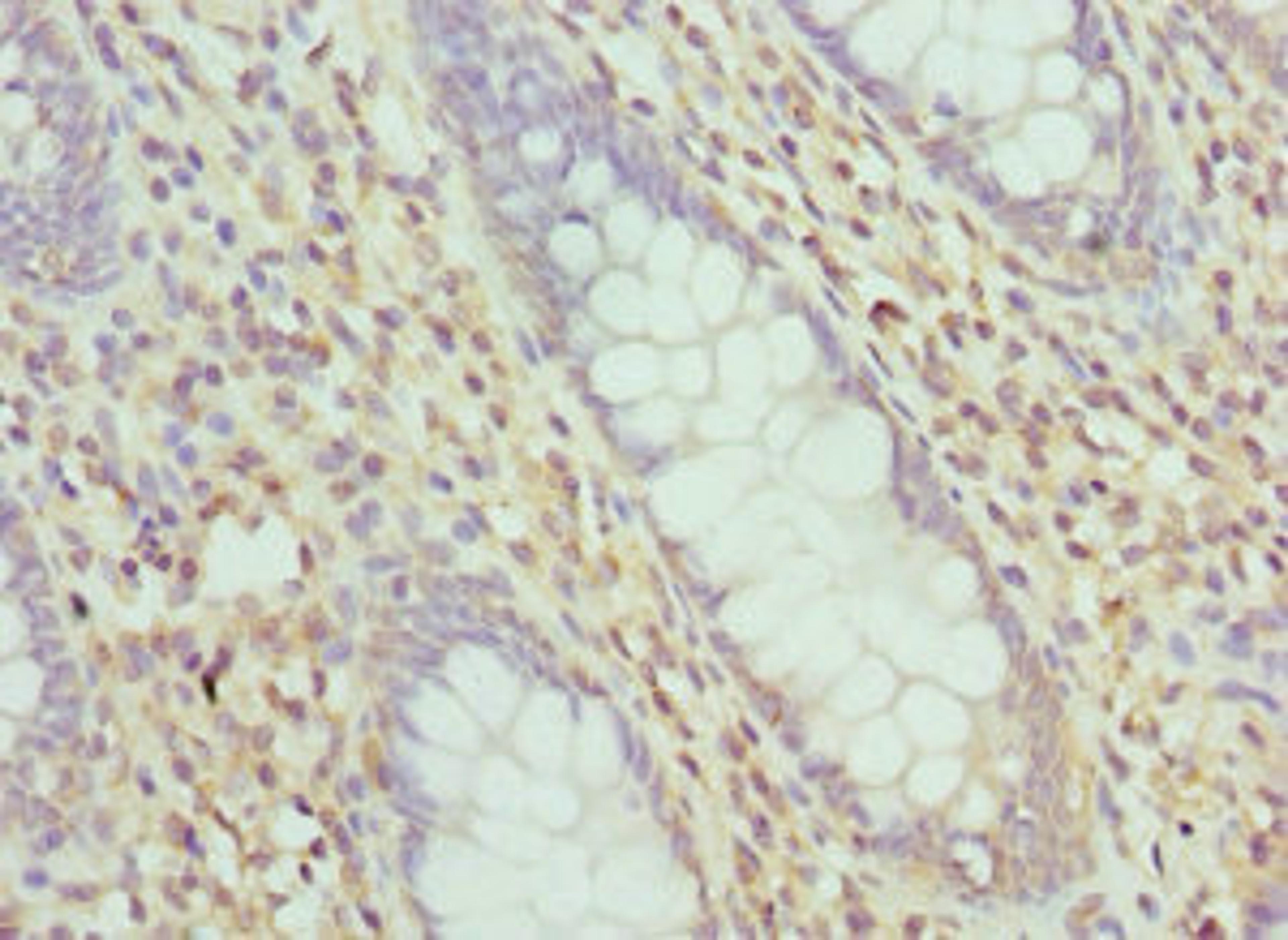 Immunohistochemistry of paraffin-embedded human colon cancer using CSB-PA012955ESR1HU at dilution of 1:100