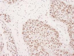 Immunohistochemistry-Paraffin: ASH2L Antibody [NB600-250] - Human laryngeal squamous cell carcinoma.  Antibody used at a dilution of 1:1000 (1ug/ml).