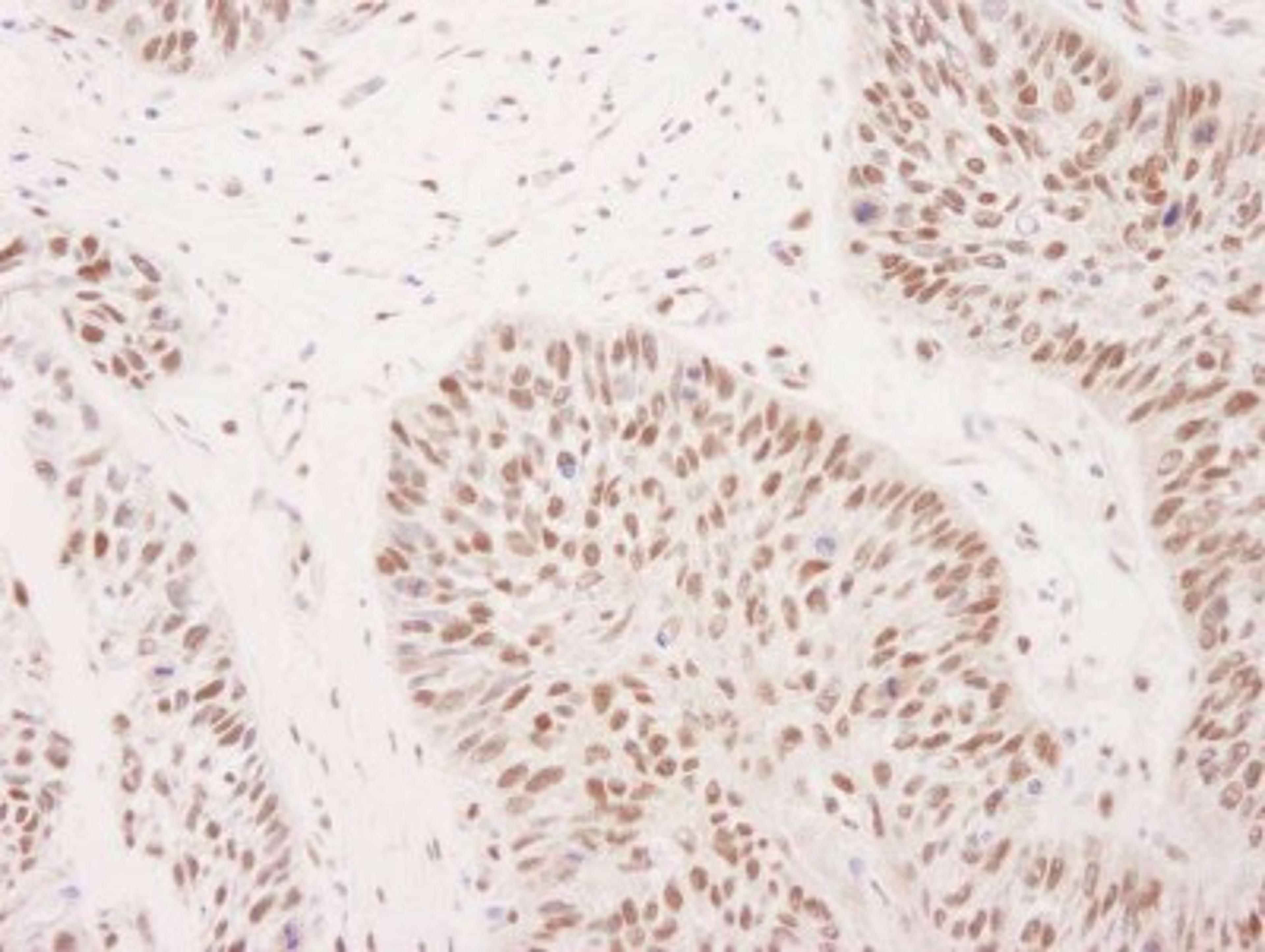 Immunohistochemistry-Paraffin: ASH2L Antibody [NB600-250] - Human laryngeal squamous cell carcinoma.  Antibody used at a dilution of 1:1000 (1ug/ml).