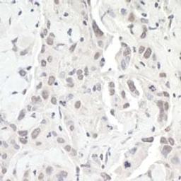 Detection of human ZEB1 by immunohistochemistry.