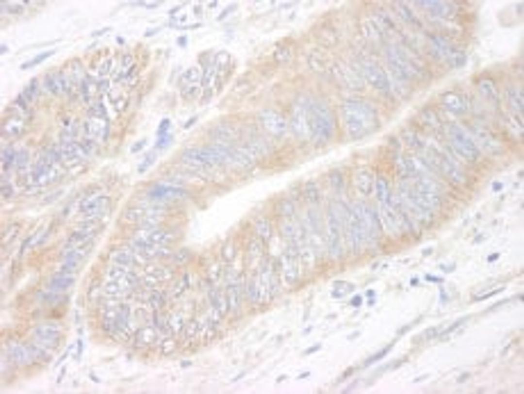 Detection of human CIP2A by immunohistochemistry.