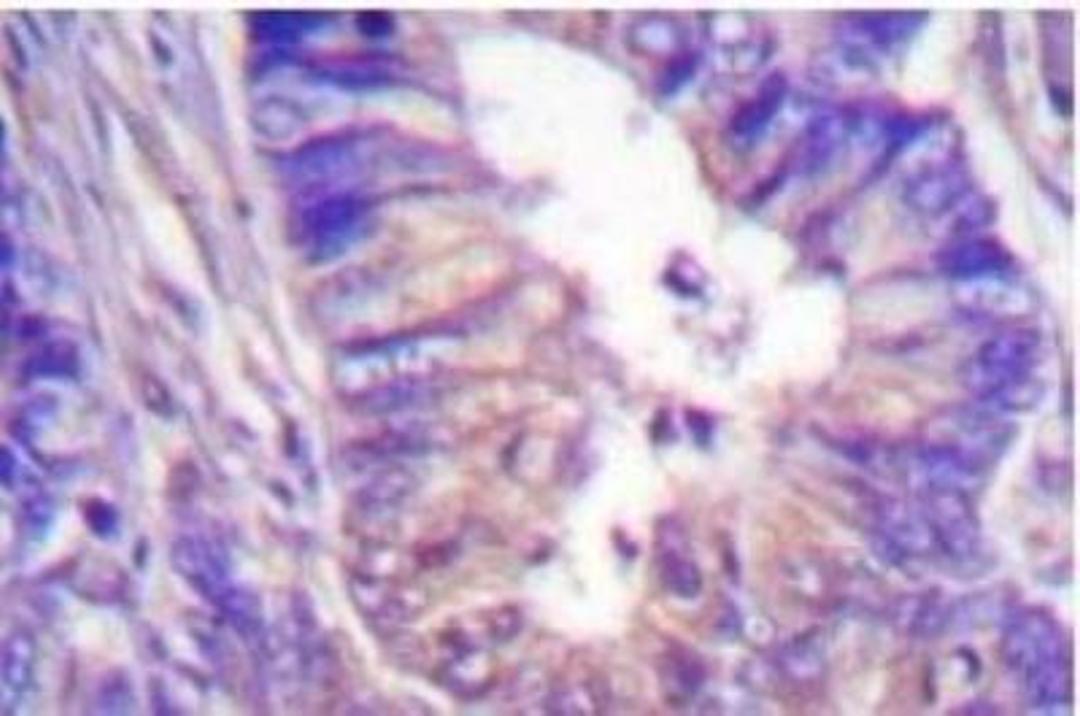 Immunohistochemistry: PKA C alpha Antibody [NB100-92207] - Immunohistochemistry (IHC) analyzes of  PKA C alpha Antibody in paraffin-embedded human colon carcinoma