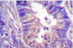 Immunohistochemistry: PKA C alpha Antibody [NB100-92207] - Immunohistochemistry (IHC) analyzes of  PKA C alpha Antibody in paraffin-embedded human colon carcinoma