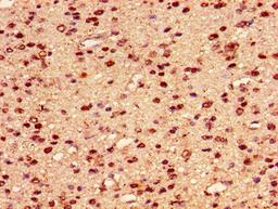 Immunohistochemistry of paraffin-embedded human glioma using CSB-PA010389PA101nogHU at dilution of 1:100