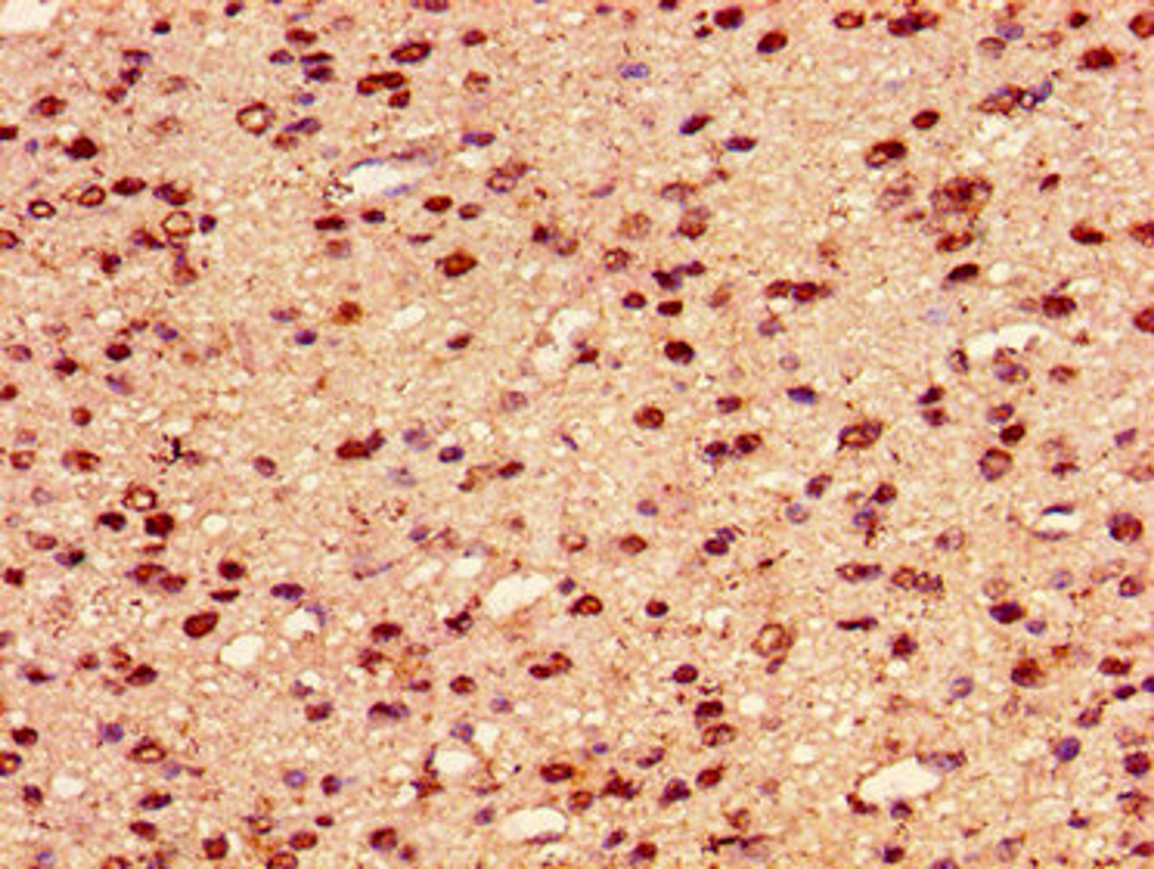 Immunohistochemistry of paraffin-embedded human glioma using CSB-PA010389PA101nogHU at dilution of 1:100