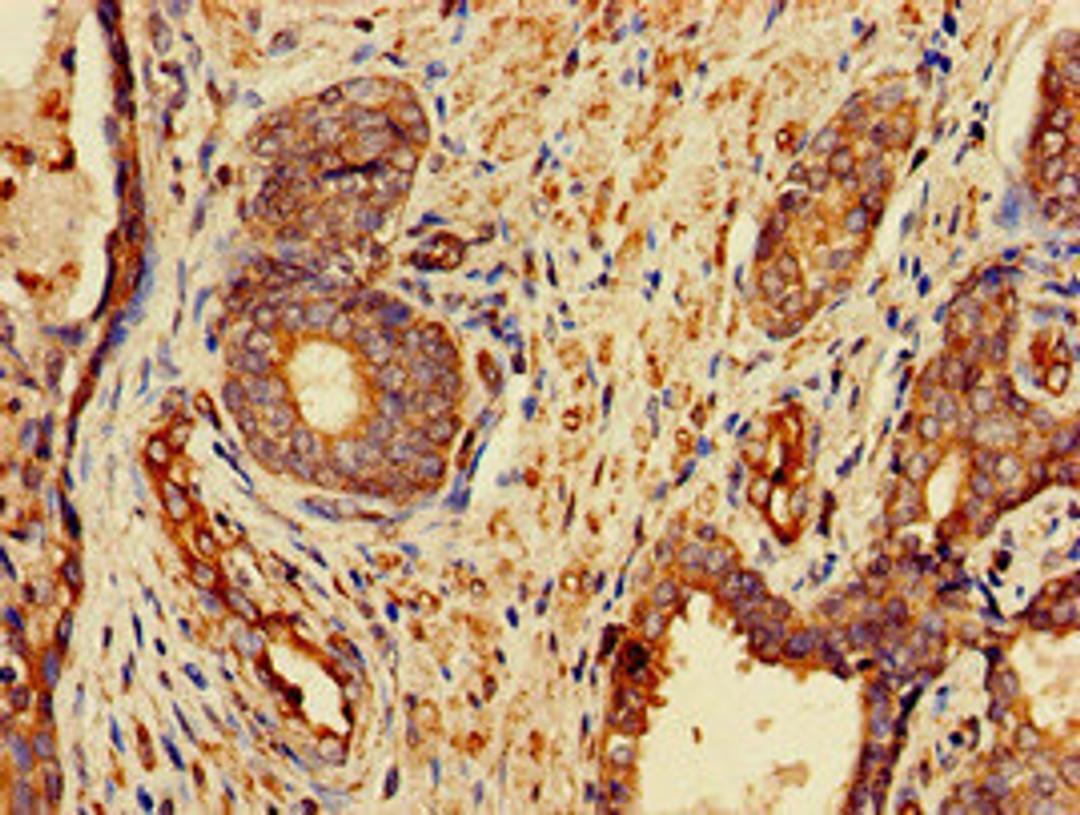 Immunohistochemistry of paraffin-embedded human prostate cancer using CSB-PA891570LA01HU at dilution of 1:100