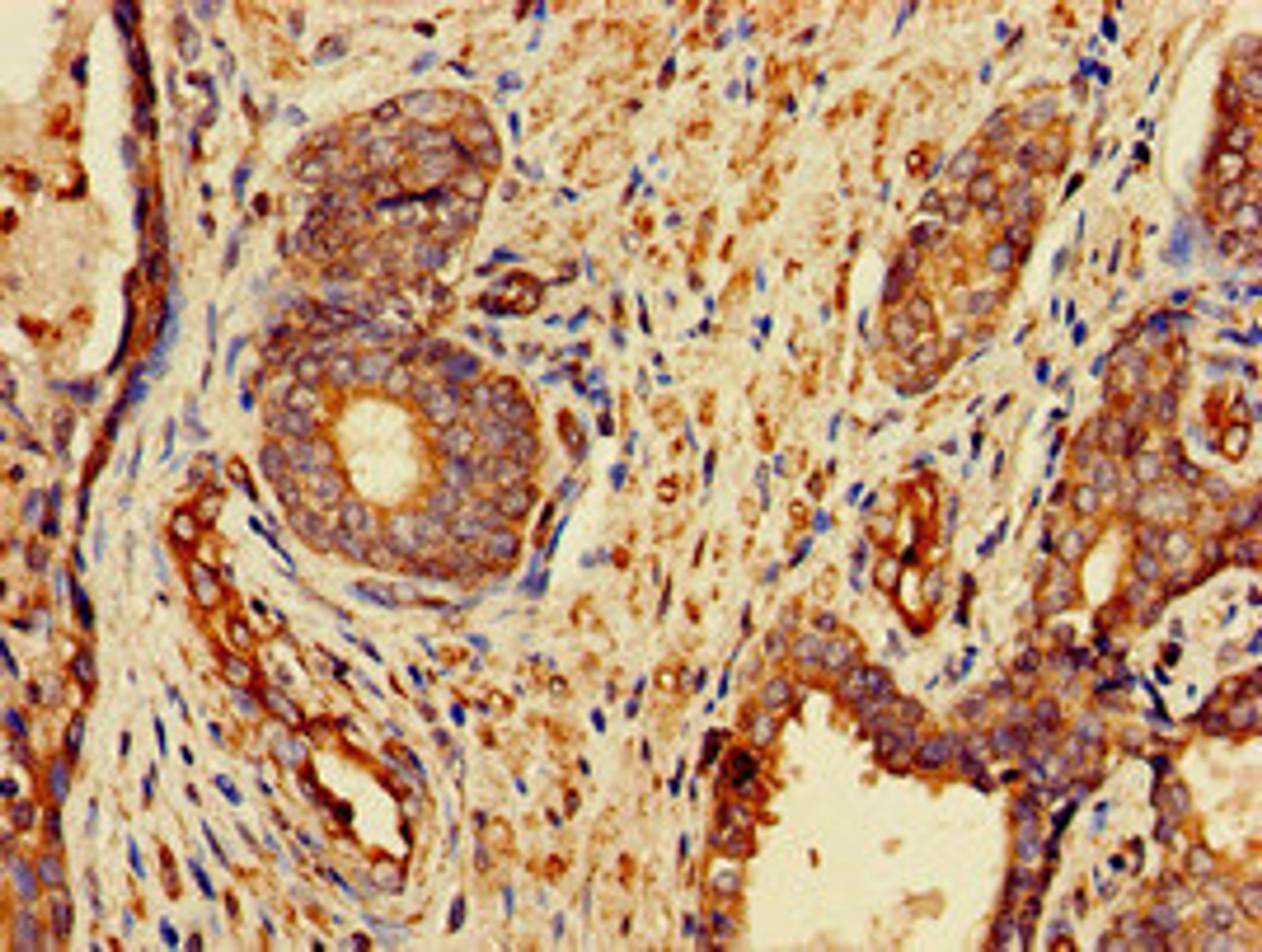 Immunohistochemistry of paraffin-embedded human prostate cancer using CSB-PA891570LA01HU at dilution of 1:100