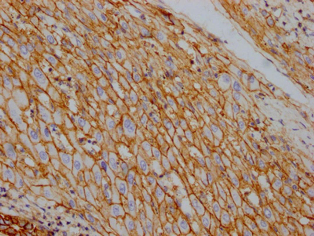 IHC image of CSB-RA796310A0HU diluted at 1:100 and staining in paraffin-embedded human liver cancer performed on a Leica BondTM system. After dewaxing and hydration, antigen retrieval was mediated by high pressure in a citrate buffer (pH 6.0). Section was blocked with 10% normal goat serum 30min at RT. Then primary antibody (1% BSA) was incubated at 4℃ overnight. The primary is detected by a Goat anti-rabbit IgG polymer labeled by HRP and visualized using 0.05% DAB.