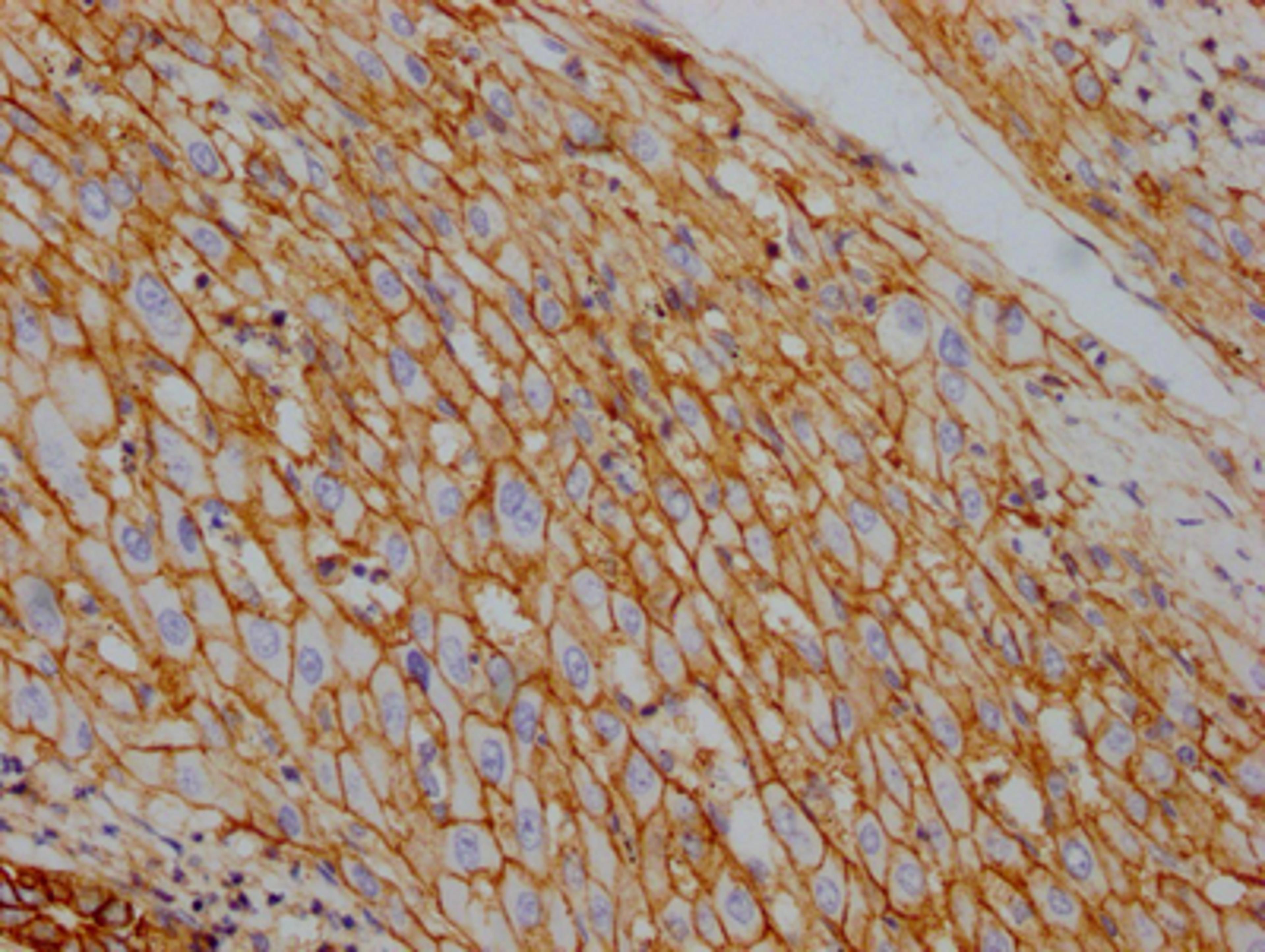 IHC image of CSB-RA796310A0HU diluted at 1:100 and staining in paraffin-embedded human liver cancer performed on a Leica BondTM system. After dewaxing and hydration, antigen retrieval was mediated by high pressure in a citrate buffer (pH 6.0). Section was blocked with 10% normal goat serum 30min at RT. Then primary antibody (1% BSA) was incubated at 4℃ overnight. The primary is detected by a Goat anti-rabbit IgG polymer labeled by HRP and visualized using 0.05% DAB.