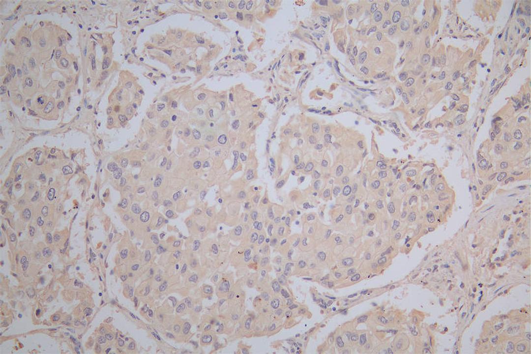 IHC image of CSB-RA878942MA1HU diluted at 1:100 and staining in paraffin-embedded human lung cancer performed on a Leica BondTM system. After dewaxing and hydration,  antigen retrieval was mediated by high pressure in a citrate buffer (pH 6.0). Section was blocked with 10% normal goat serum 30min at RT. Then primary antibody (1% BSA) was incubated at 4°C overnight. The primary is detected by a Goat anti-Mouse IgG labeled by HRP and visualized using 0.05% DAB.