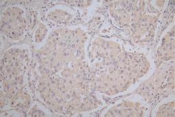 IHC image of CSB-RA878942MA1HU diluted at 1:100 and staining in paraffin-embedded human lung cancer performed on a Leica BondTM system. After dewaxing and hydration,  antigen retrieval was mediated by high pressure in a citrate buffer (pH 6.0). Section was blocked with 10% normal goat serum 30min at RT. Then primary antibody (1% BSA) was incubated at 4°C overnight. The primary is detected by a Goat anti-Mouse IgG labeled by HRP and visualized using 0.05% DAB.