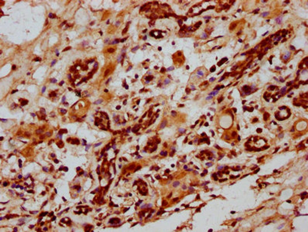 IHC image of CSB-PA010967LA01HU diluted at 1:1000 and staining in paraffin-embedded human breast cancer performed on a Leica BondTM system. After dewaxing and hydration, antigen retrieval was mediated by high pressure in a citrate buffer (pH 6.0). Section was blocked with 10% normal goat serum 30min at RT. Then primary antibody (1% BSA) was incubated at 4&deg;C overnight. The primary is detected by a biotinylated secondary antibody and visualized using an HRP conjugated SP system.